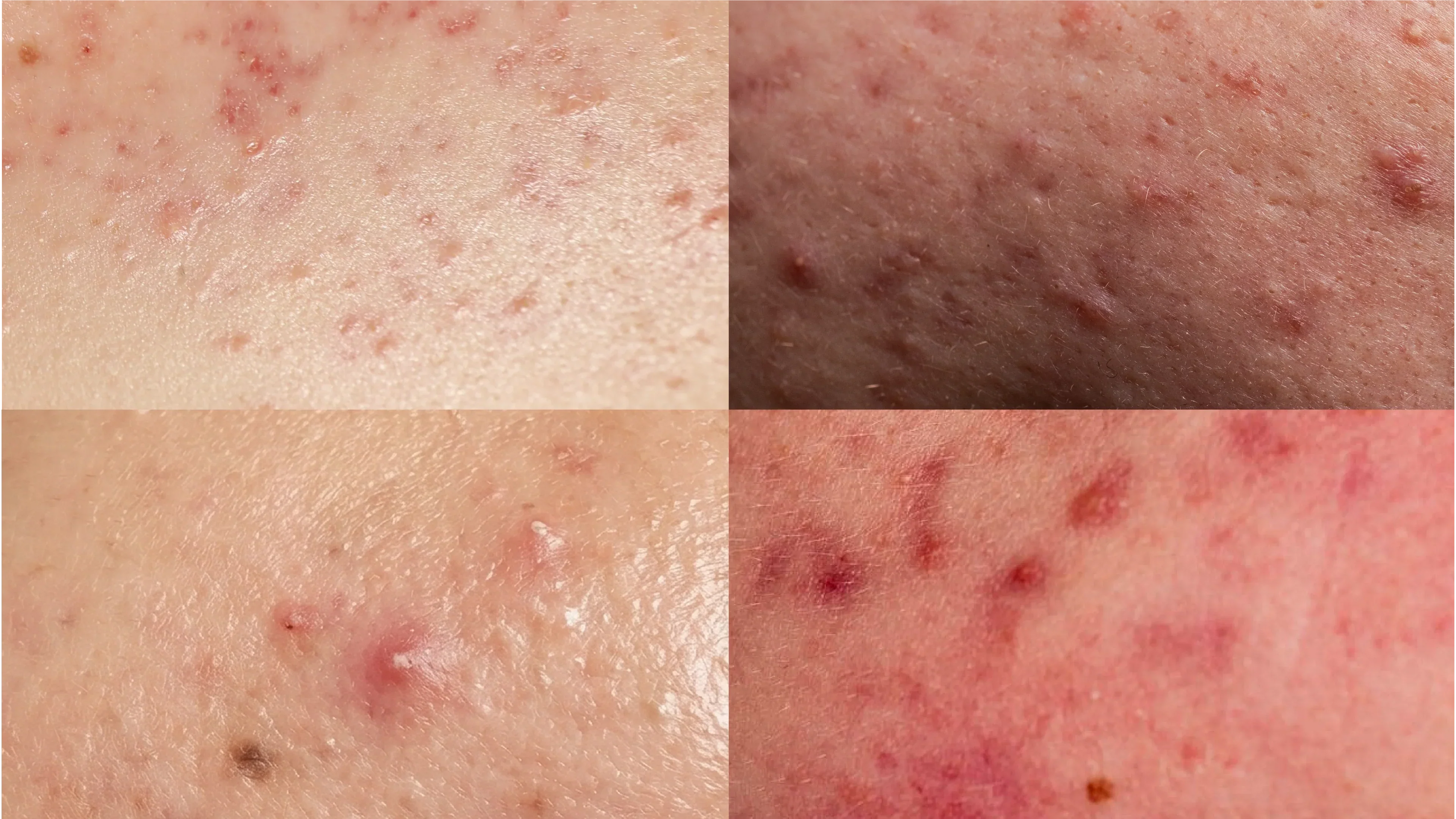 Acne doesn’t come from just one cause!