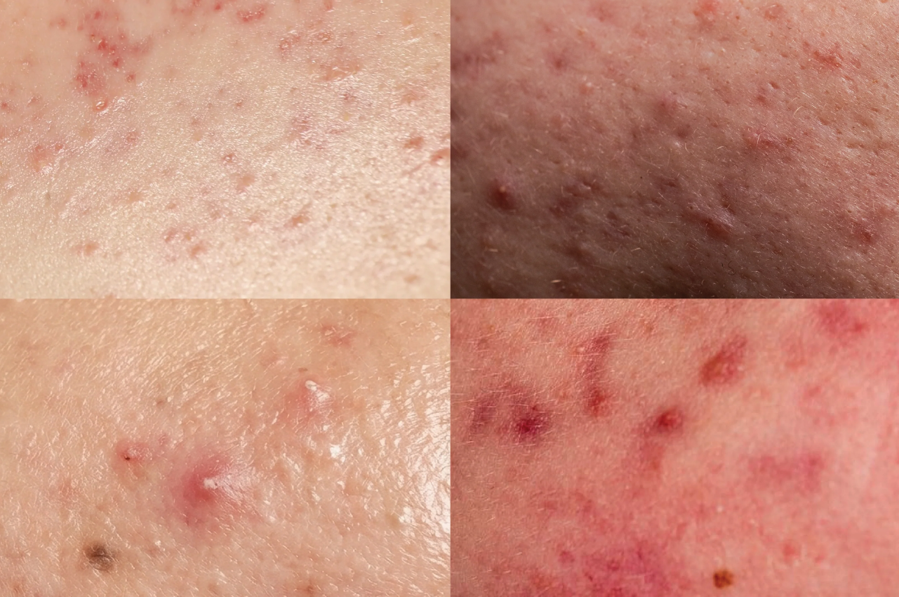Acne doesn’t come from just one cause!