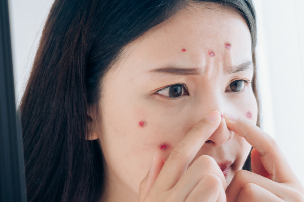 So, can I pop a pimple?