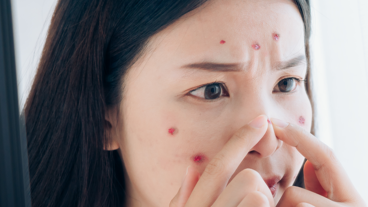 So, can I pop a pimple?