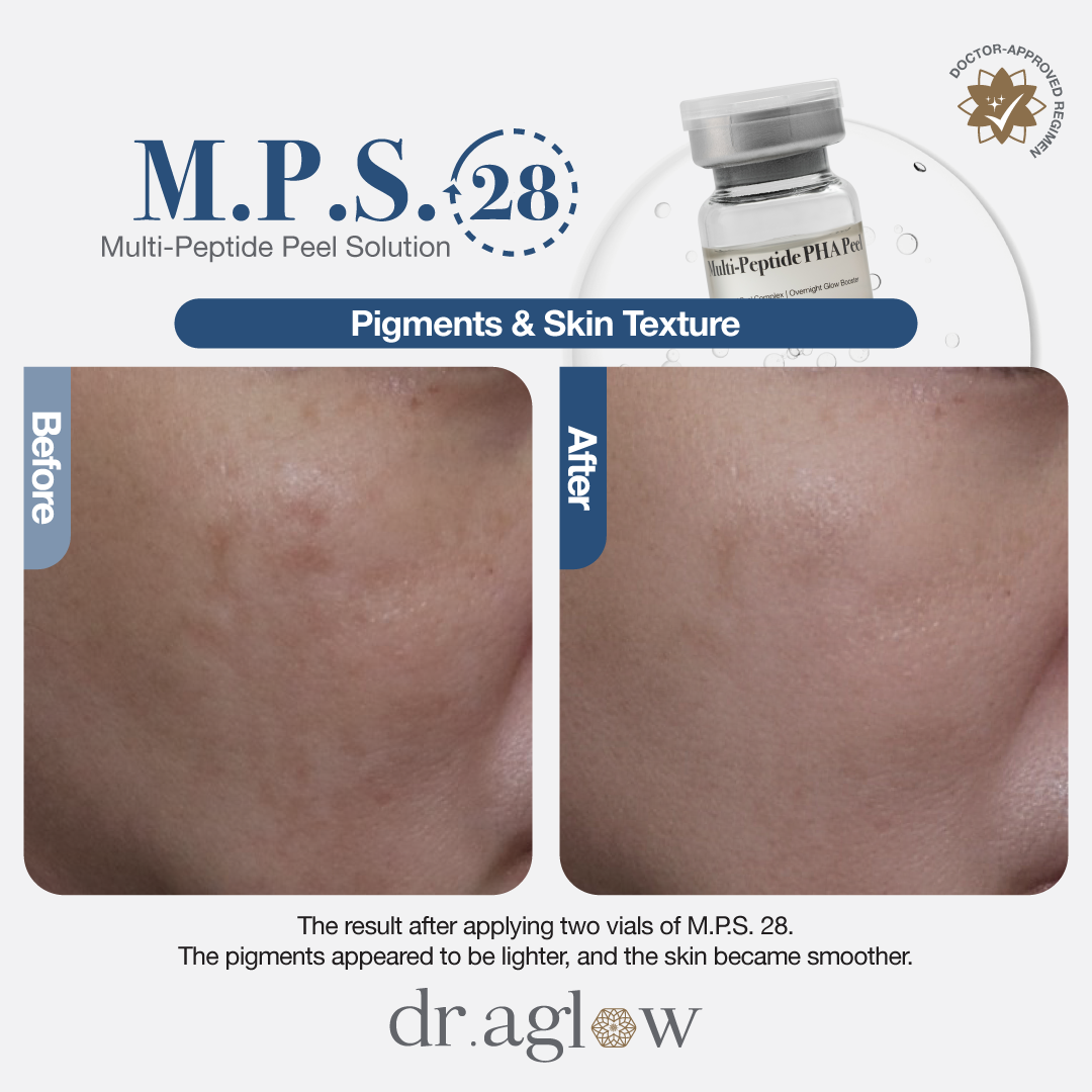 M.P.S. 28 (Single Vial)