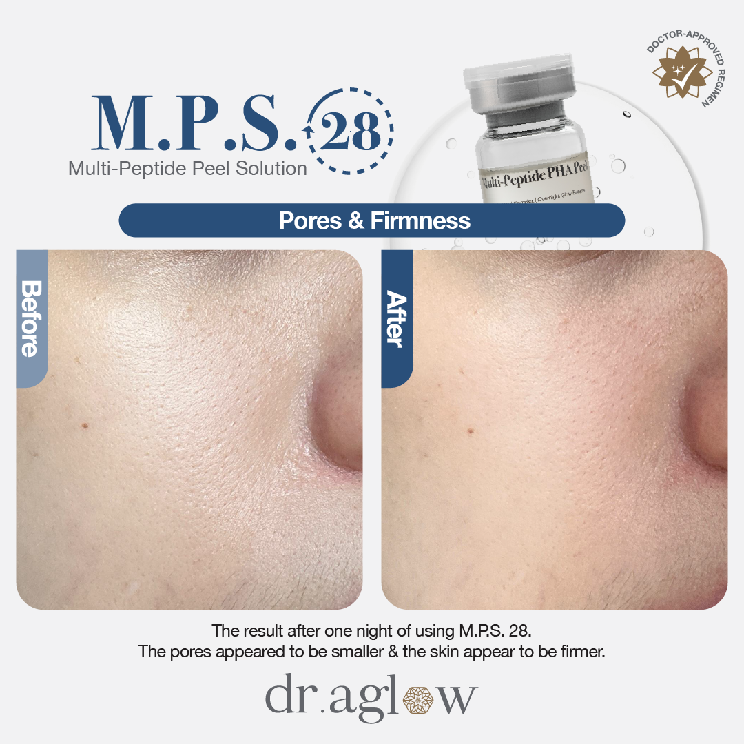 M.P.S. 28 (Single Vial)